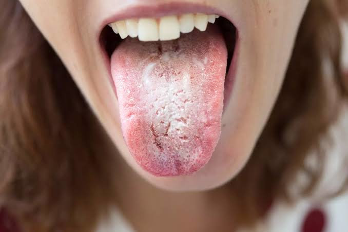 Candida: 10 typische Symptome einer Candida-Infektion